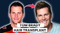 Does tom brady have hair implants?