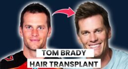 Does tom brady have hair implants?