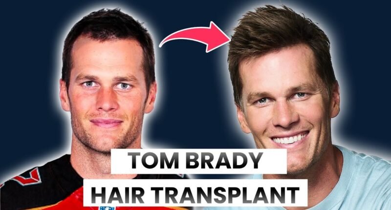 Does tom brady have hair implants?