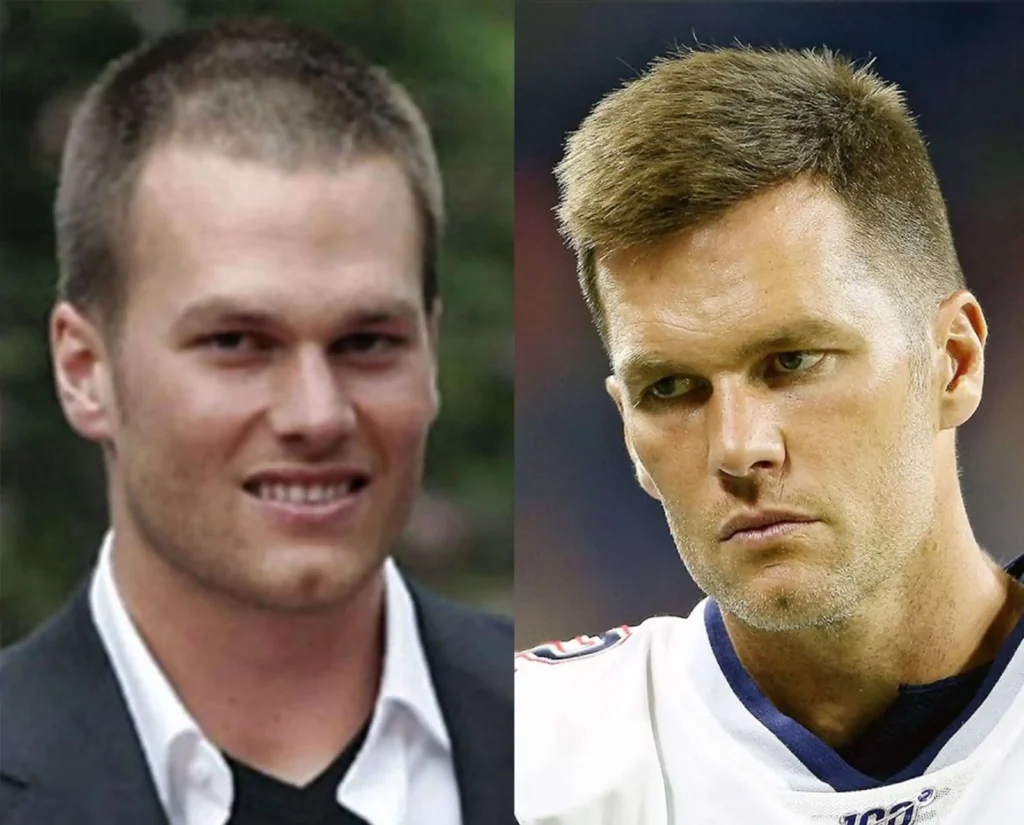 Does tom brady have hair implants?